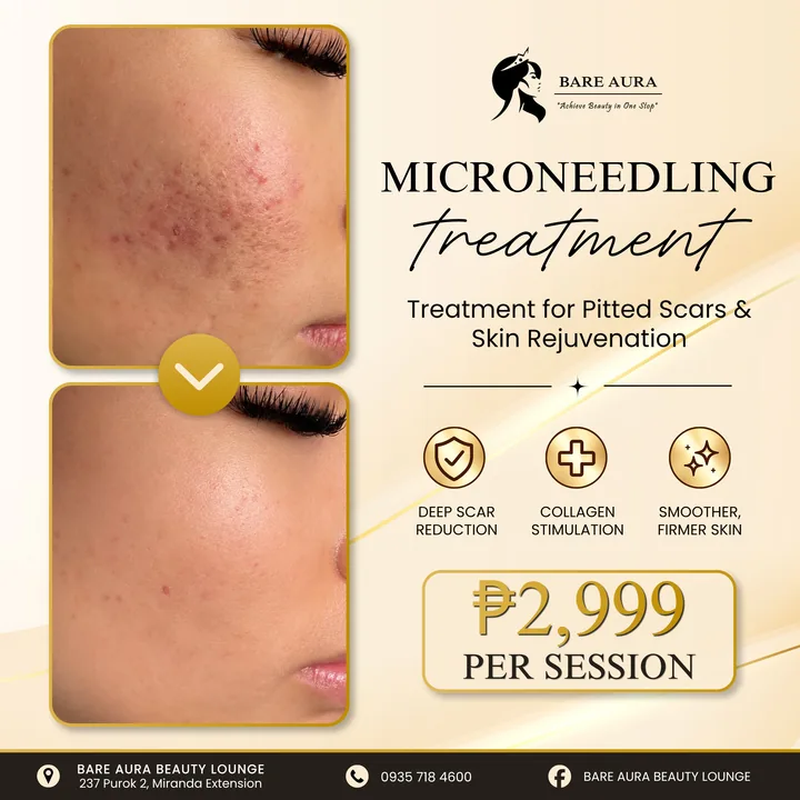 Before-and-after post: microneedling treatment for pitted scars